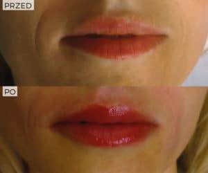 efekt powiększania ust